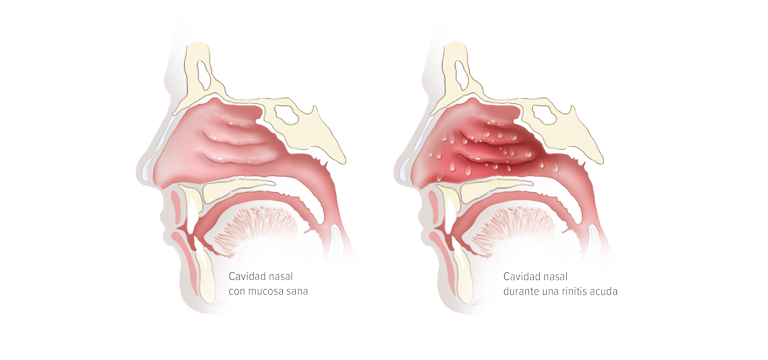 Mucosa nasal inflamada - Apoteca Natura