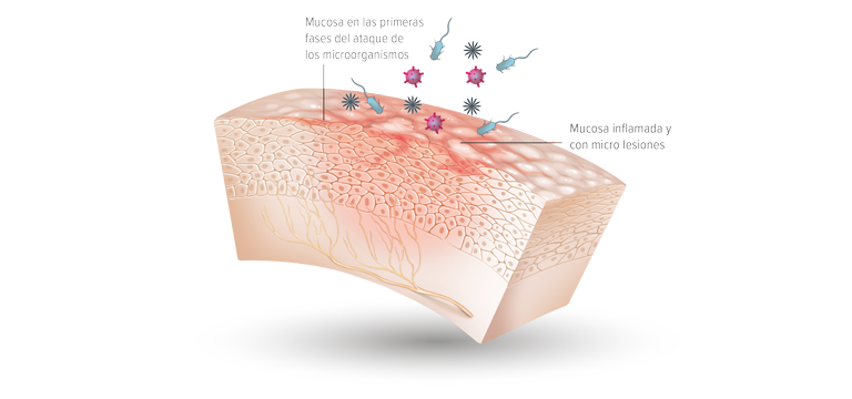 Inflamación de la mucosa de la faringe - Apoteca Natura