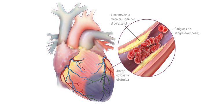 Arterosclerosis - Apoteca Natura