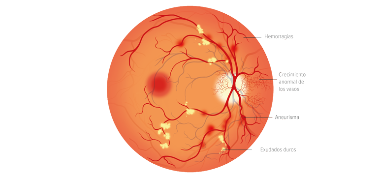 Retinopatía diabética - Apoteca Natura