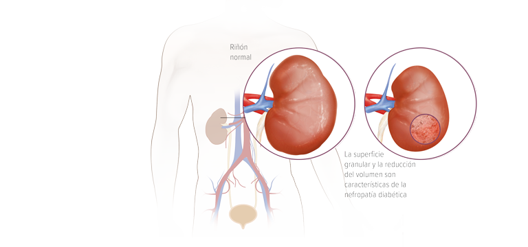 Nefropatía diabética - Apoteca Natura