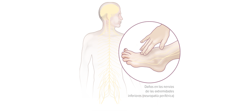 Neuropatía diabética - Apoteca Natura