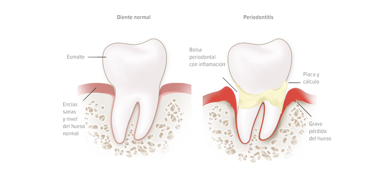 periodontitis - Apoteca Natura