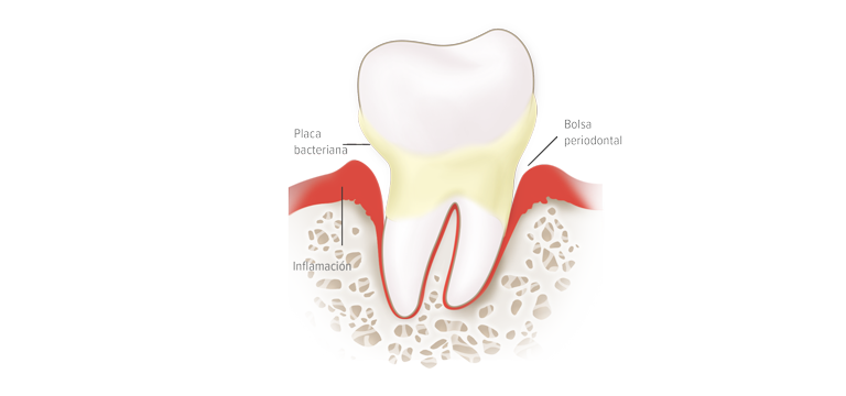 Las bolsas periodontales - Apoteca Natura