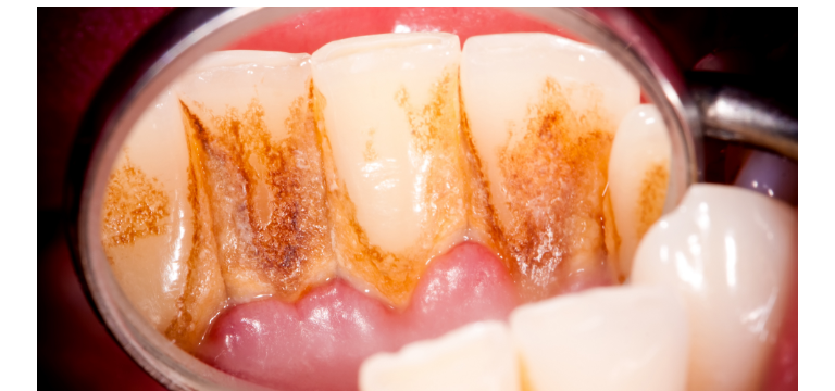 periodontitis - Apoteca Natura