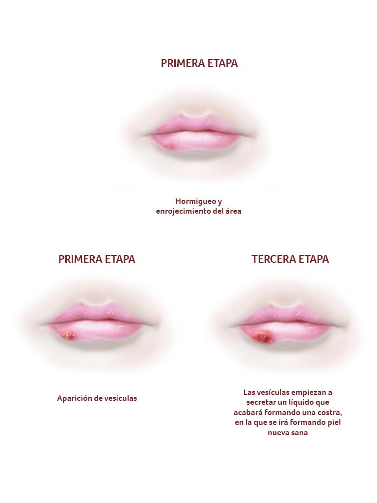 herpes - Apoteca Natura