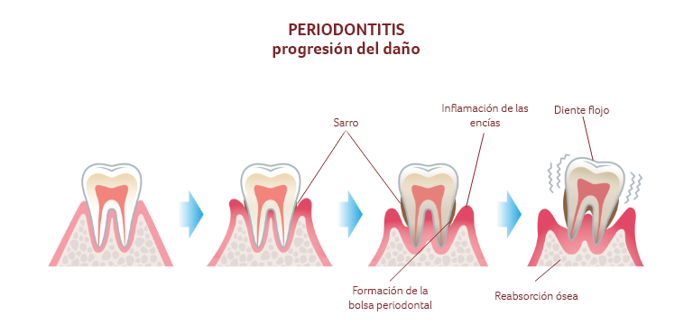 bacterias e inflamación gingival - Apoteca Natura