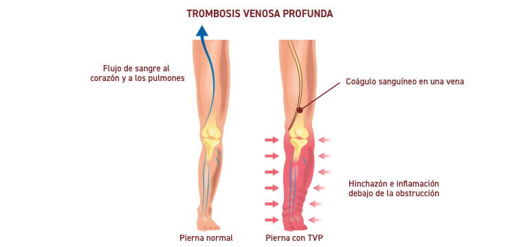 Trombosis venosa profunda (flebotrombosis profunda) - Apoteca Natura