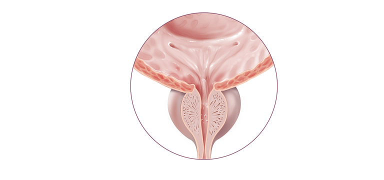 Síndrome de dolor pelviano crónico no-inflamatorio - Apoteca Natura