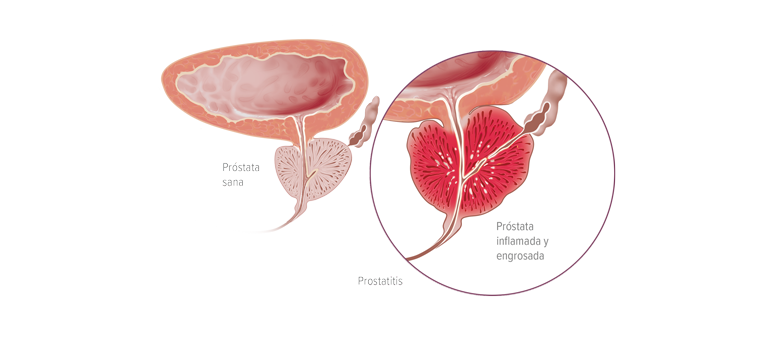 Prostatitis bacteriana aguda - Apoteca Natura