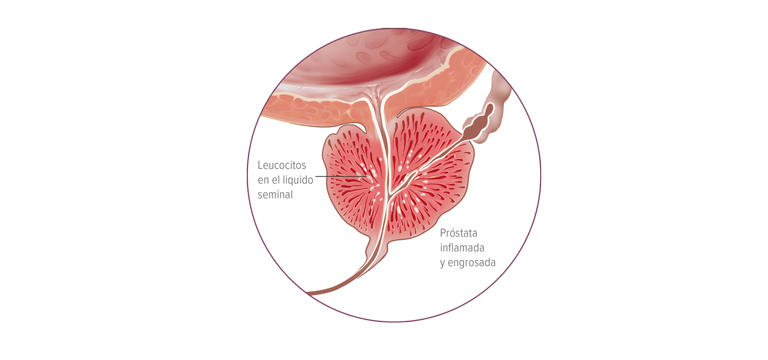 Síndrome de dolor pelviano crónico inflamatorio - Apoteca Natura