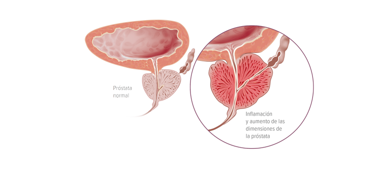 Prostatitis - Apoteca Natura